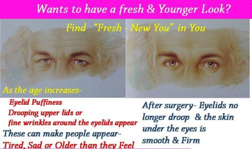 blepharoplasty-eyelid-nose-surgery-surat-valsad-navsari-bharuch-vapi-vadodara-uk-usa-4-2