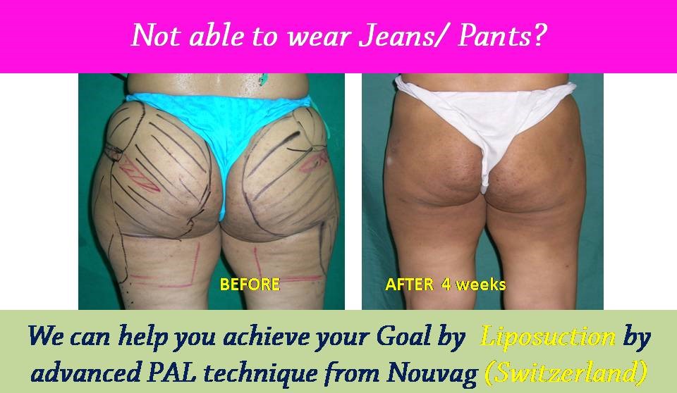 liposuction-results-surat-valsad-navsari-bharuch-vapi-vadodara-mumbai-1-2