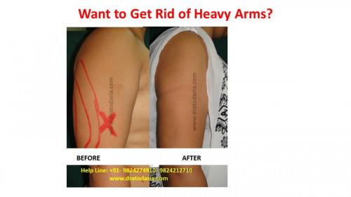 Arms-liposuction-brachioplasty-heavy-surat-best-results-clinis-doctor-gujarat-ankleshwar-bharuch-navsari-valsad-1