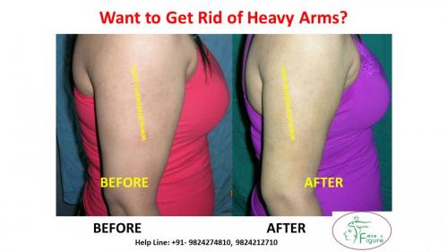 Arms-liposuction-brachioplasty-heavy-surat-best-results-clinis-doctor-gujarat-ankleshwar-bharuch-navsari-valsad-2b