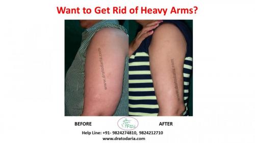 Arms-liposuction-brachioplasty-heavy-surat-best-results-clinis-doctor-gujarat-ankleshwar-bharuch-navsari-valsad-3a