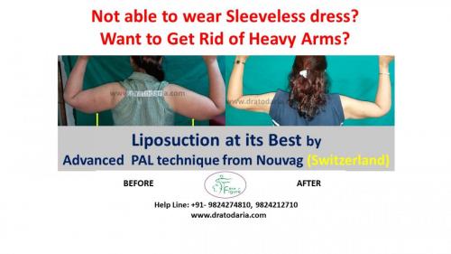 Arms-liposuction-brachioplasty-heavy-surat-best-results-clinis-doctor-gujarat-ankleshwar-bharuch-navsari-valsad-3c