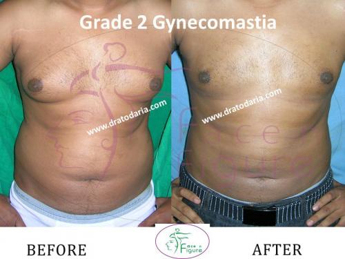Gynecomastia-doctor-clinic-surat-smart-Navsari-valsad-bharuch-ankleshwar-baroda-1 (2)