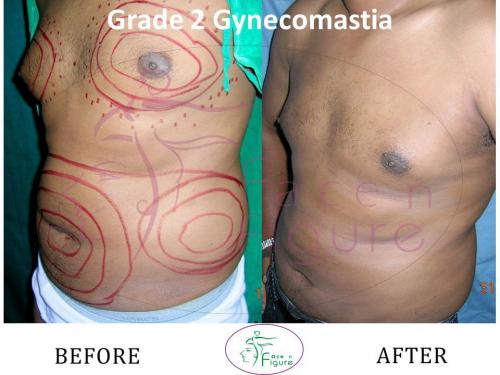 Gynecomastia-doctor-clinic-surat-smart-Navsari-valsad-bharuch-ankleshwar-baroda-1 (4)