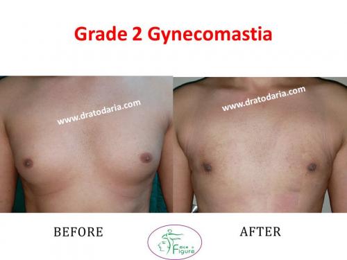 Gynecomastia-doctor-clinic-surat-smart-Navsari-valsad-bharuch-ankleshwar-baroda-1 (5)