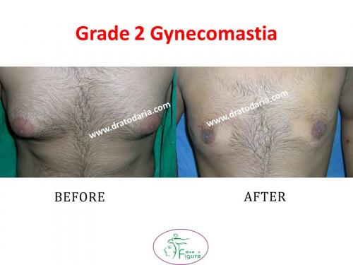 Gynecomastia-doctor-clinic-surat-smart-Navsari-valsad-bharuch-ankleshwar-baroda-1
