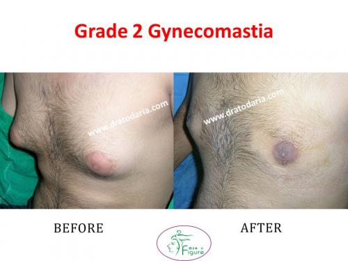 Gynecomastia-doctor-clinic-surat-smart-Navsari-valsad-bharuch-ankleshwar-baroda-3