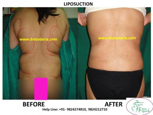 Liposuction-back-tummy-surat-best-results-clinic-usa-uk-Bharuch-Navsari