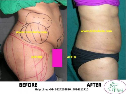 Liposuction-female-buts-tummy-surat-best-results-clinic-usa-uk-Bharuch-Navsari-2