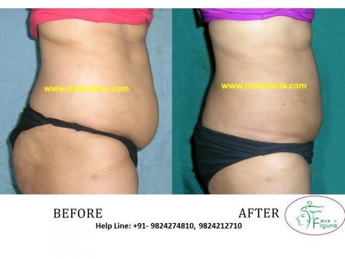Liposuction-female-love handles-tummy-surat-best-results-clinic-usa-uk-Bharuch-Navsari-1
