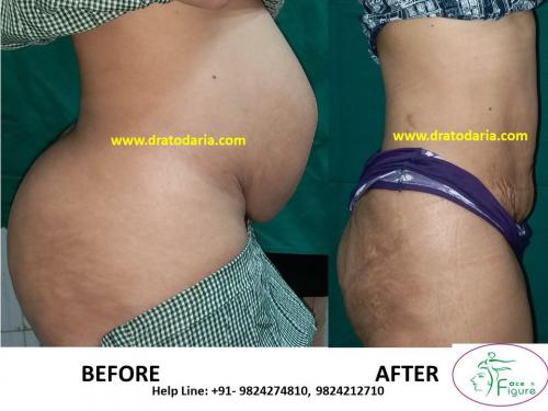 Liposuction-heavy buttoks-surat-bharuc-navsari-valsad-usa-uk-best-clinic-results-India-3