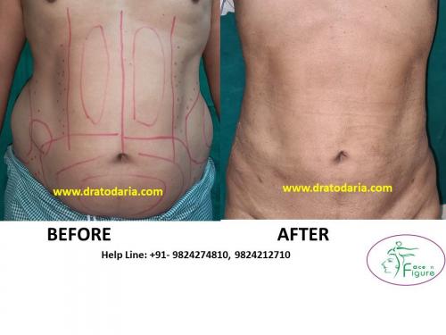 Liposuction-love handles-tummy-surat-best-results-clinic-usa-uk-Bharuch-Navsari=Valsad-1