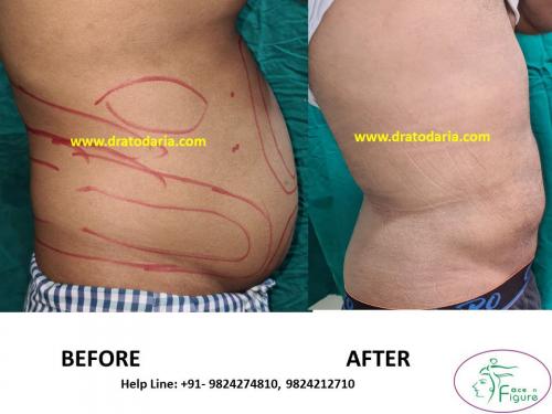 Liposuction-love handles-tummy-surat-best-results-clinic-usa-uk-Bharuch-Navsari=Valsad-5