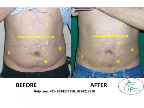 Liposuction-love handles-tummy-surat-best-results-clinic-usa-uk-Bharuch-Navsari=Valsad