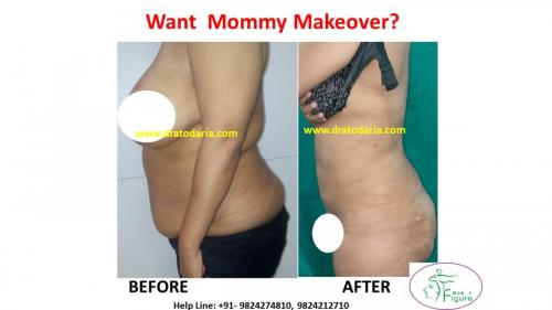 Mommy-makeover-Surat-Bharuch-Navsari-Valsad-Gujarat-Best-results-clinic-doctor-USA-UK-3
