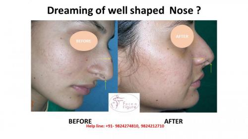 Rhinoplasty- Deviated-Nose -Hump-Surgery-Best-Results-Clinic-Surat-Baroda-Gujarat-Navsari-3