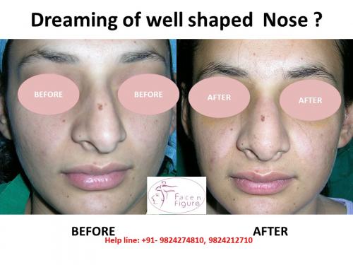 Rhinoplasty- Deviated-Nose -Surgery-Best-Results-Clinic-Surat-Baroda-Gujarat-Navsari-11