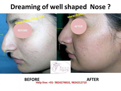 Rhinoplasty- Deviated-Nose -Surgery-Best-Results-Clinic-Surat-Baroda-Gujarat-Navsari-12