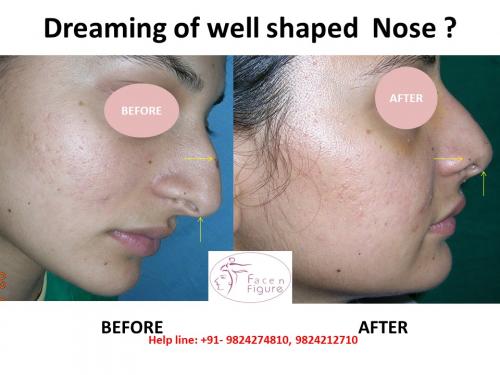 Rhinoplasty- Deviated-Nose -Surgery-Best-Results-Clinic-Surat-Baroda-Gujarat-Navsari-13