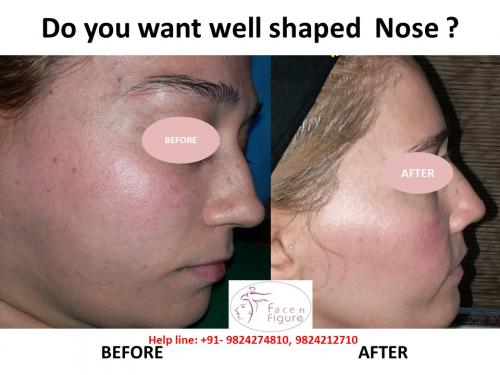 Rhinoplasty- Deviated-Nose -Surgery-Best-Results-Clinic-Surat-Baroda-Gujarat-Navsari-16