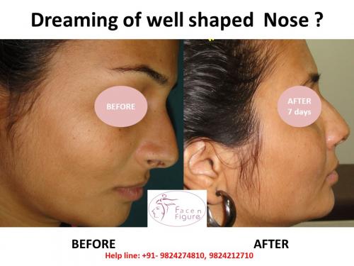 Rhinoplasty- Deviated-Nose -Surgery-Best-Results-Clinic-Surat-Baroda-Gujarat-Navsari-22