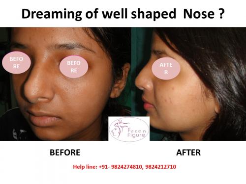 Rhinoplasty For Deviated Nose