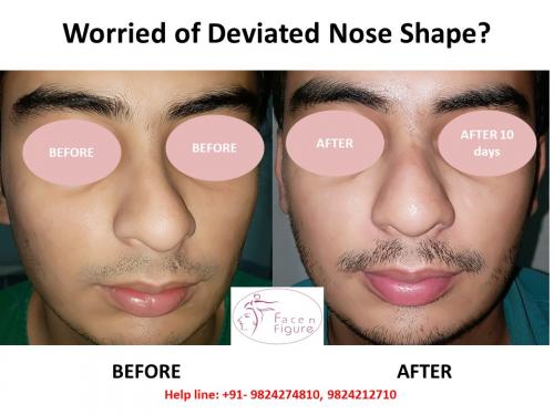 Rhinoplasty- Deviated-Nose -Surgery-Best-Results-Clinic-Surat-Baroda-Gujarat-Navsari-8