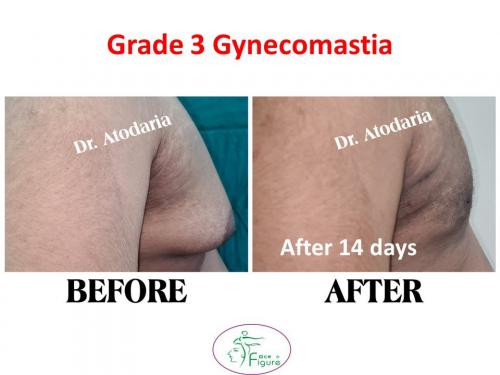 Gynecomastia