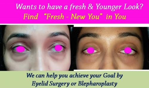Eye Lid Surgery