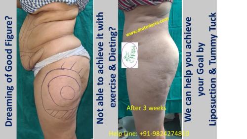 Best-liposuction-surat-gujarat-india-clinic-doctor-surgeon